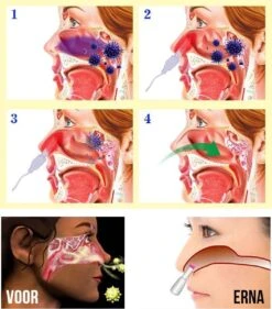 Merkloos Allernieuwste Rhinitis Sinusitis Fototherapie Neus Apparaat - Hooikoorts - Draagbaar -Zelfzorg Winkel 1054x1200 1