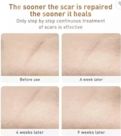 LANBENA Littekencrème - Vermindert Zichtbaarheid Van Littekens – Acné En Striae Littekens - Herstelt De Huid - Litteken Crème Tube 30ml -Zelfzorg Winkel 1071x1200 5