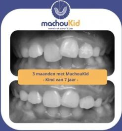 Machoukid Mondstuk Van 6-15 Jaar - Stoppen Met De Speen / Duimen - Tandenknarsen - Medical Grade -Zelfzorg Winkel 1122x1200 1