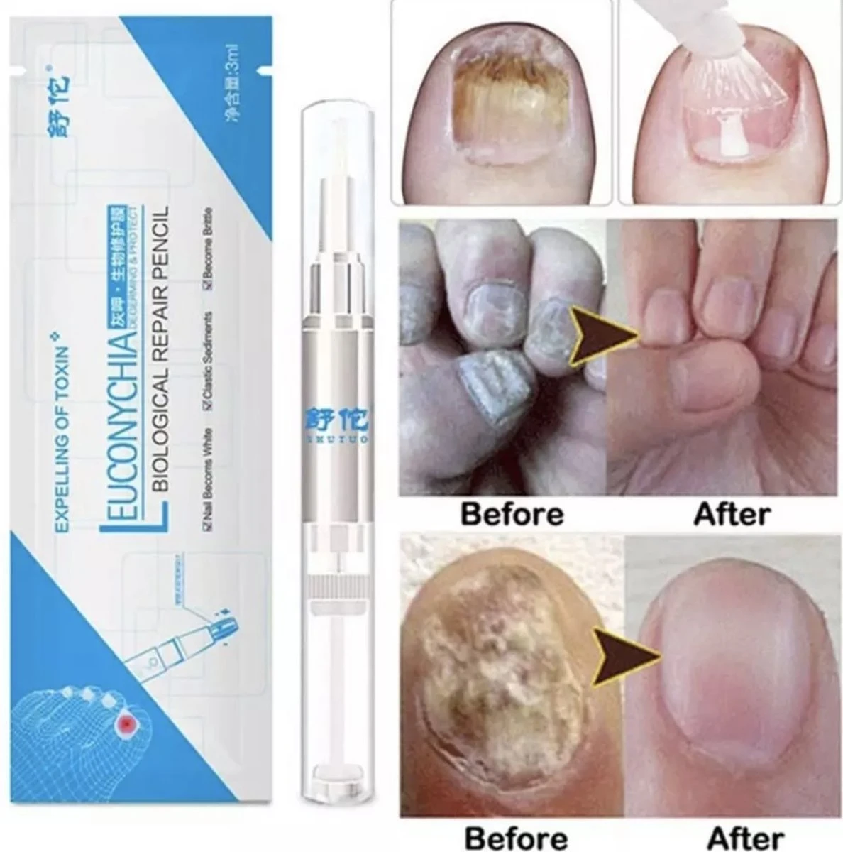 Nagelbehandeling Behandeling - 7 Dagen - Serum - Voet/hand - Kalk/schimmelnagel 4 Nagelbehandeling Behandeling - 7 Dagen - Serum - Voet/hand - Kalk/schimmelnagel - Afbeelding 2