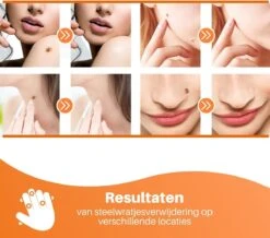 JT Beauty Care Steelwratjes Thuiskit - Steelwratjes Verwijderen - 2-7 Mm - Skin Tags - Gemakkelijk, Snel En Pijnloos -Zelfzorg Winkel 1200x1057 1