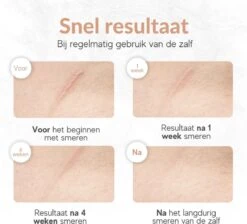 Dermapro Littekencrème 2 Pack- Vermindert Zichtbaarheid Van Littekens – Acné En Striae Littekens - Herstelt De Huid - Litteken Crème Tube 30ml 11 Dermapro Littekencrème 2 Pack- Vermindert Zichtbaarheid Van Littekens – Acné En Striae Littekens - Herstelt De Huid - Litteken Crème Tube 30ml -Zelfzorg Winkel 1200x1089 2