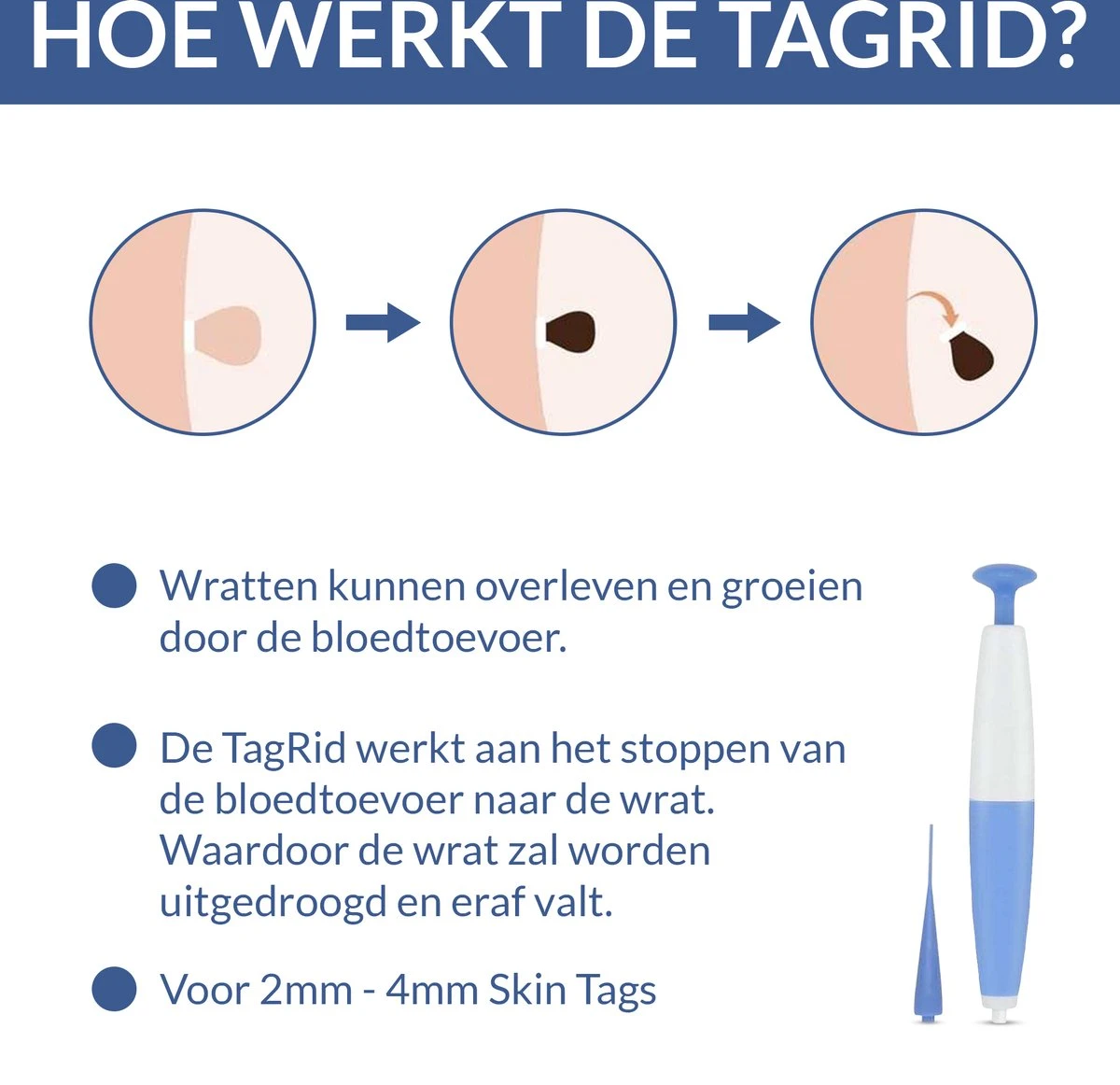 TagRid - Wratten - Wrattenpen - Wrattenbehandeling - Wrattenverwijderaar - Steelwratjes Verwijderaar - Pijnloos - 7 TagRid - Wratten - Wrattenpen - Wrattenbehandeling - Wrattenverwijderaar - Steelwratjes Verwijderaar - Pijnloos - - Afbeelding 5