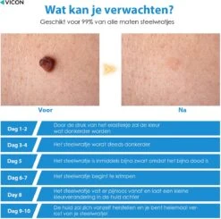 Vicon Steelwratjes Verwijderen Pro - 2-8MM - Pijnloos En Snel - Incl. Huidpleisters - Skin Tags Verwijderen - Wrattenverwijderaar - Steelwratten Pen 16 Vicon Steelwratjes Verwijderen Pro - 2-8MM - Pijnloos En Snel - Incl. Huidpleisters - Skin Tags Verwijderen - Wrattenverwijderaar - Steelwratten Pen -Zelfzorg Winkel 1200x1191 4