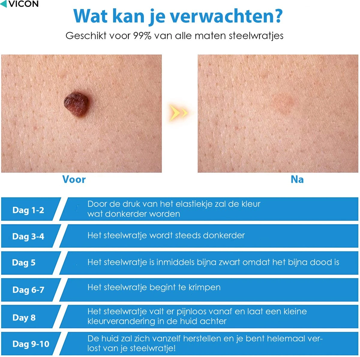 Vicon Steelwratjes Verwijderen Pro - 2-8MM - Pijnloos En Snel - Incl. Huidpleisters - Skin Tags Verwijderen - Wrattenverwijderaar - Steelwratten Pen 9 Vicon Steelwratjes Verwijderen Pro - 2-8MM - Pijnloos En Snel - Incl. Huidpleisters - Skin Tags Verwijderen - Wrattenverwijderaar - Steelwratten Pen - Afbeelding 7