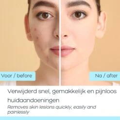 Orange Care, Skin Tag Remover – 15ml, Fibromen Verwijderen, Huidverzorging -Zelfzorg Winkel 1200x1200 538