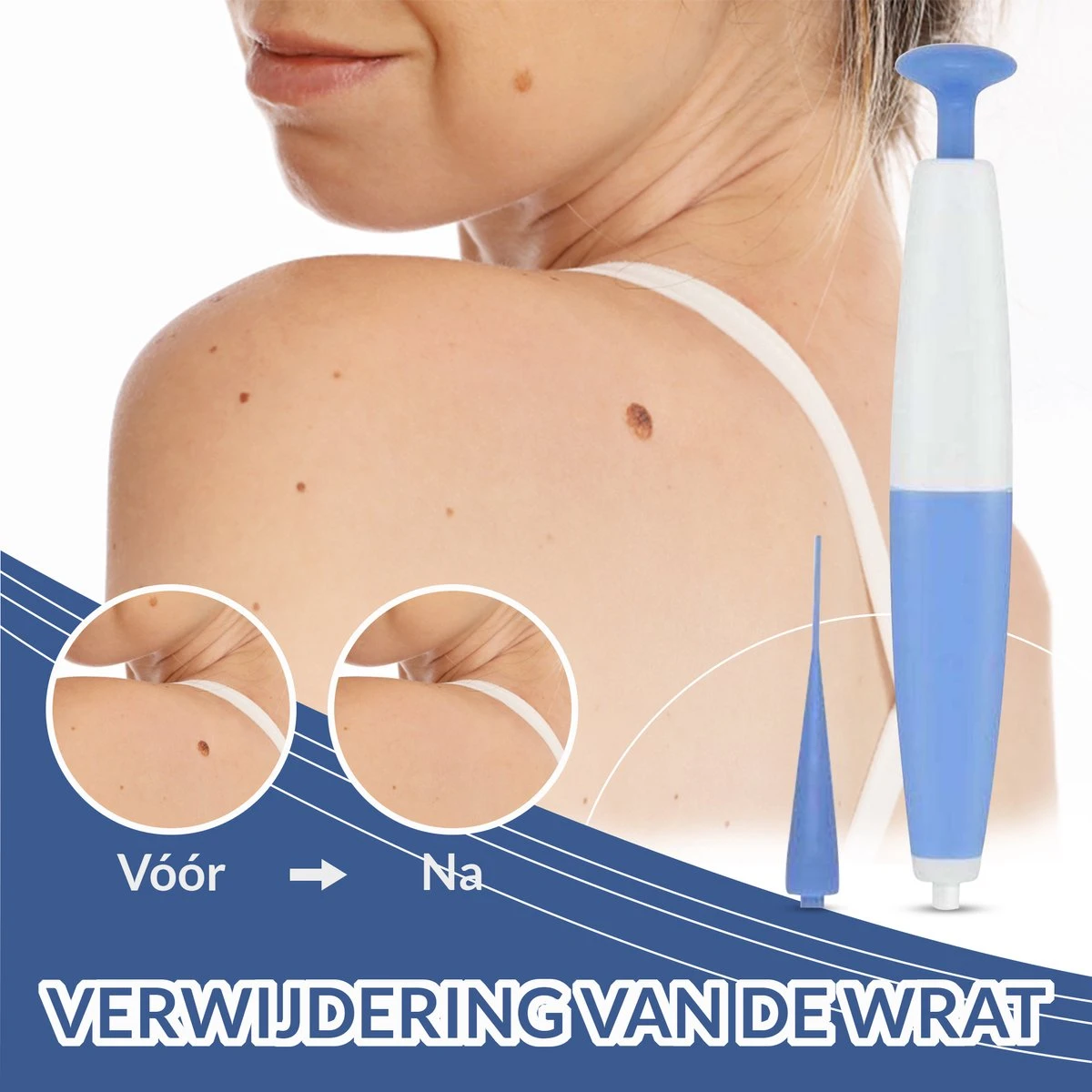 TagRid - Wratten - Wrattenpen - Wrattenbehandeling - Wrattenverwijderaar - Steelwratjes Verwijderaar - Pijnloos - 4 TagRid - Wratten - Wrattenpen - Wrattenbehandeling - Wrattenverwijderaar - Steelwratjes Verwijderaar - Pijnloos - - Afbeelding 2