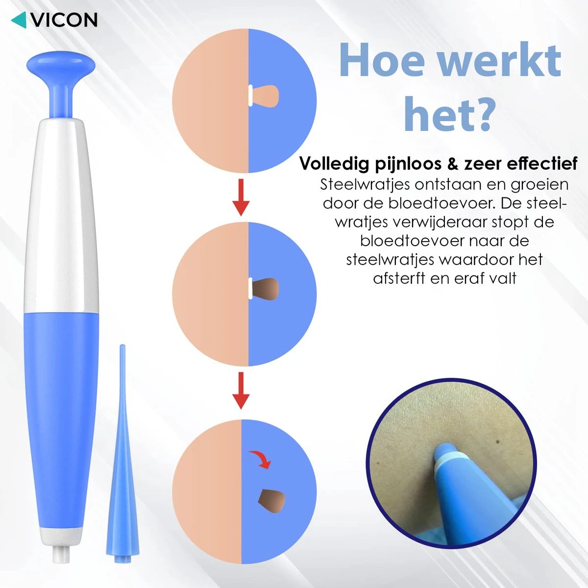 Vicon Steelwratjes Verwijderen - 2-5MM - Pijnloos En Snel - Incl. Huidpleisters - Skin Tags Verwijderen - Wrattenverwijderaar - Steelwratten Pen 5 Vicon Steelwratjes Verwijderen - 2-5MM - Pijnloos En Snel - Incl. Huidpleisters - Skin Tags Verwijderen - Wrattenverwijderaar - Steelwratten Pen - Afbeelding 3