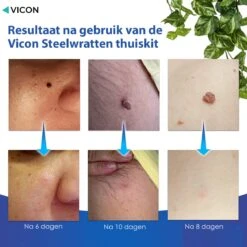 Vicon Steelwratjes Verwijderen - 2-5MM - Pijnloos En Snel - Incl. Huidpleisters - Skin Tags Verwijderen - Wrattenverwijderaar - Steelwratten Pen 16 Vicon Steelwratjes Verwijderen - 2-5MM - Pijnloos En Snel - Incl. Huidpleisters - Skin Tags Verwijderen - Wrattenverwijderaar - Steelwratten Pen -Zelfzorg Winkel 1200x1200 561