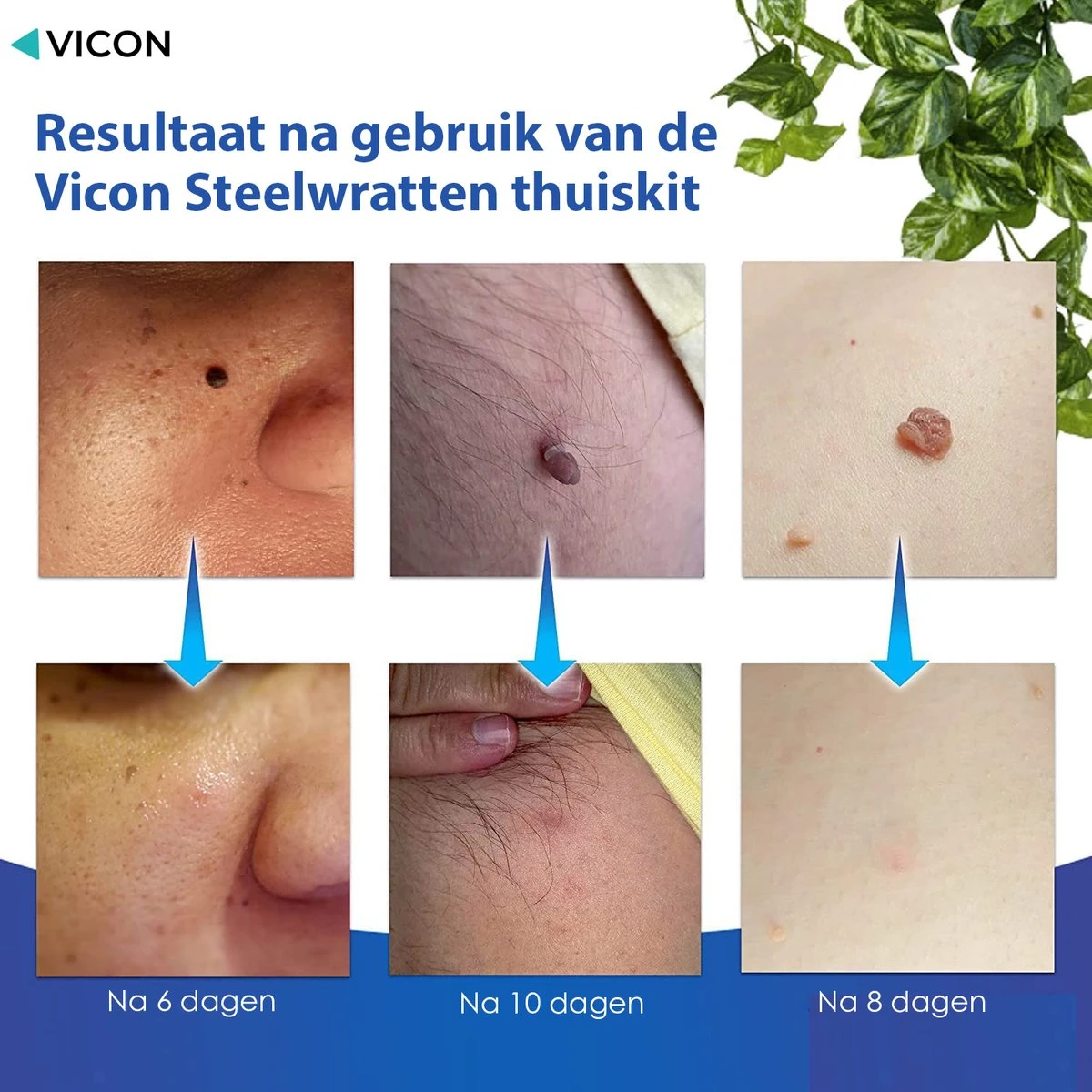 Vicon Steelwratjes Verwijderen - 2-5MM - Pijnloos En Snel - Incl. Huidpleisters - Skin Tags Verwijderen - Wrattenverwijderaar - Steelwratten Pen 9 Vicon Steelwratjes Verwijderen - 2-5MM - Pijnloos En Snel - Incl. Huidpleisters - Skin Tags Verwijderen - Wrattenverwijderaar - Steelwratten Pen - Afbeelding 7