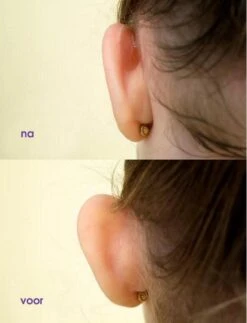 OTOSTICK - Oorcorrectie Stickers - Flapoorstickers - Voor Baby's En Kinderen Tot 4 Jaar - 8 Stuks 15 OTOSTICK - Oorcorrectie Stickers - Flapoorstickers - Voor Baby's En Kinderen Tot 4 Jaar - 8 Stuks -Zelfzorg Winkel 919x1200 2